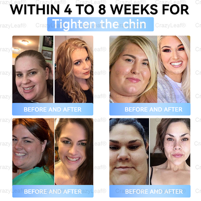 C US 🏥FDA Store | 𝐵uil𝗱𝐿ea𝐟® 𝑺𝑀𝗚T-𝑮𝐋𝑃-1 𝐒limming & 𝐻ealth 𝑁ano 𝑀icroneedle 𝑃atch with Collagen & Matrixyl 3000 丨Obesity,Cardiovascular Diseas, Diabetes, Sleep Apnea, Joint Problems and More