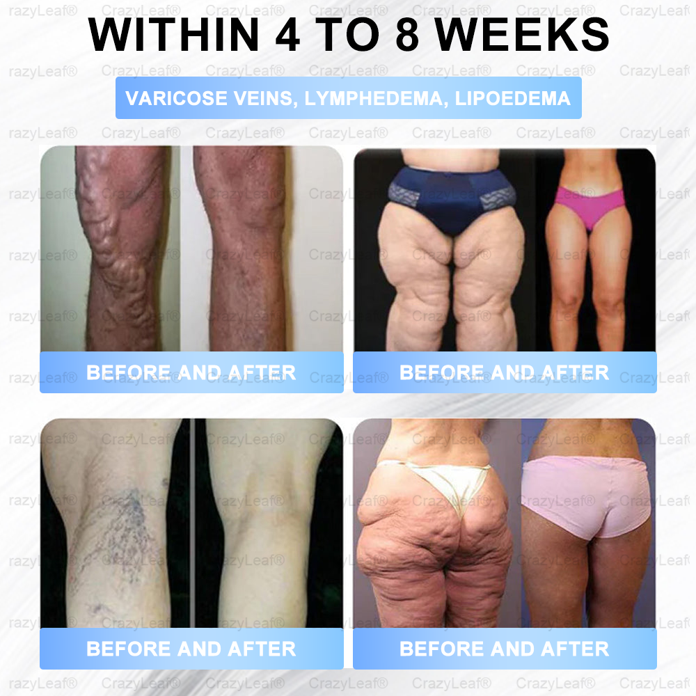 C US 🏥FDA Store | 𝐵uil𝗱𝐿ea𝐟® 𝑺𝑀𝗚T-𝑮𝐋𝑃-1 𝐒limming & 𝐻ealth 𝑁ano 𝑀icroneedle 𝑃atch with Collagen & Matrixyl 3000 丨Obesity,Cardiovascular Diseas, Diabetes, Sleep Apnea, Joint Problems and More