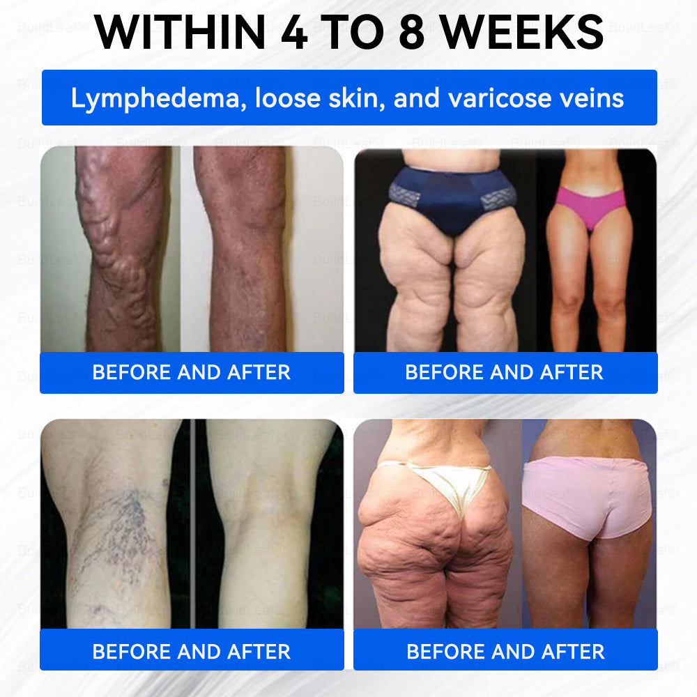 Official Store | BuildLeaf® SMGT-GLP-1 Nano Microneedle Patch with Collagen & Matrixyl 3000 丨Obesity,Cardiovascular Diseas, Diabetes, Sleep Apnea, Joint Problems and More